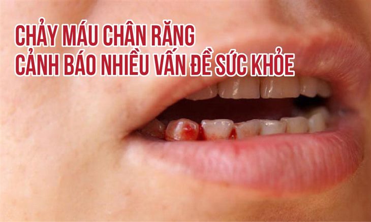 Chảy máu chân răng cảnh báo nhiều vấn đề sức khỏe