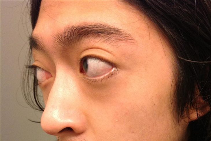   Người bị bướu cổ basedow thường gặp các biến chứng về mắt