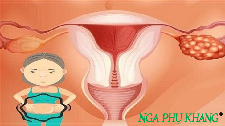  Đau bụng có thể là dấu hiệu cảnh báo u nang buồng trứng tái phát