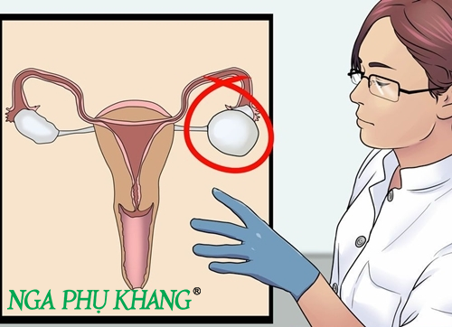 Có nhiều chị em trong độ tuổi sinh sản bị mắc u nang buồng trứng