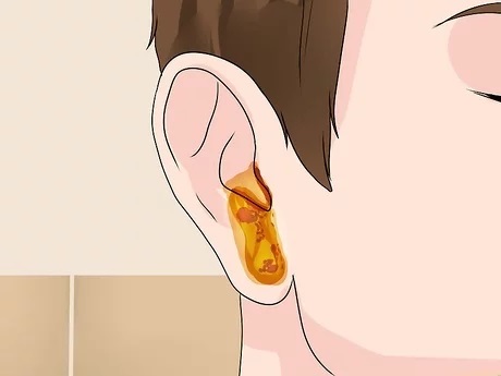 Viêm nhiễm ở tai dễ gây nghe kém, điếc tai