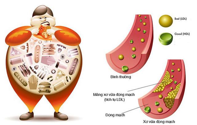   Những người thừa cân, béo phì có nguy cơ cao bị mỡ máu Những người thừa cân, béo phì có nguy cơ cao bị mỡ máu