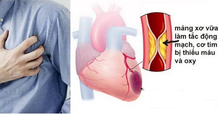    Mỡ máu cao có thể dẫn đến xơ vữa động mạch