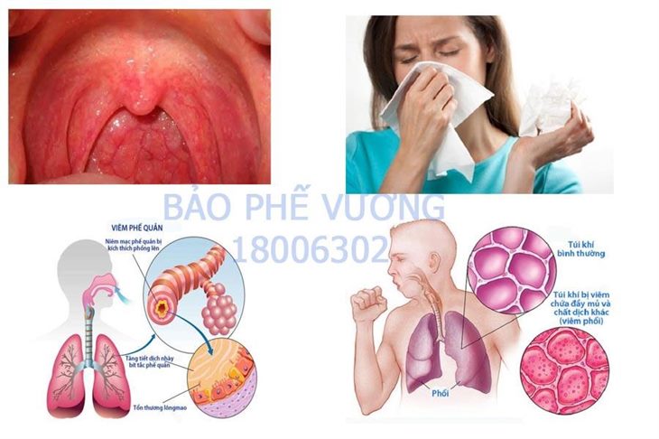 Bị vướng đờm ở cổ họng là biểu hiện của nhiều bệnh viêm đường hô hấp