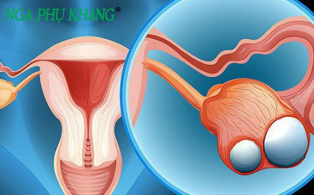U nang buồng trứng là bệnh phụ khoa phổ biến ở nữ giới
