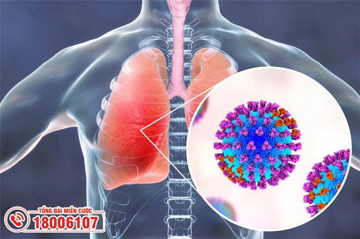 Bệnh sởi có thể gây biến chứng viêm phổi nặng