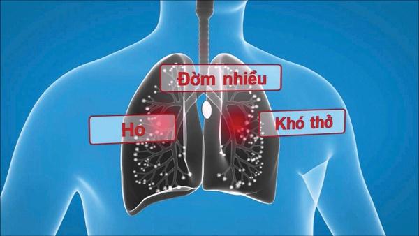   Ho đờm đặc kèm khó thở là biểu hiện của bệnh viêm phổi mạn tính