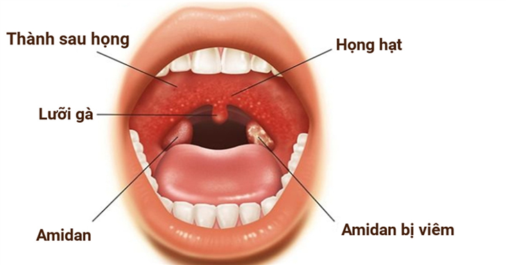 Viêm họng hạt là sự xuất hiện của các hạt li ti ở niêm mạc họng