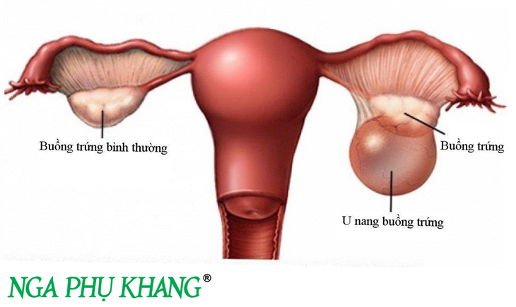 Phụ nữ bị u nang buồng trứng phải kích thước nhỏ vẫn có thể mang thai