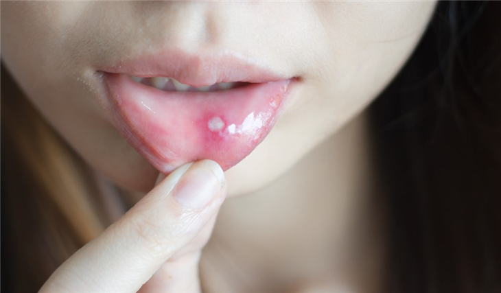 Nhiệt miệng gây bất tiện cho bệnh nhân