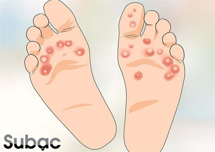 Trẻ nổi mụn nước ở lòng bàn chân có thể là biểu hiện của bệnh tay chân miệng