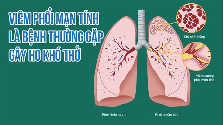 Viêm phổi mạn tính là bệnh thường gặp gây ho khó thở