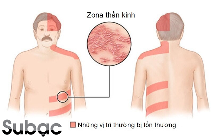 Zona thần kinh thường xuất hiện ở lưng, bụng