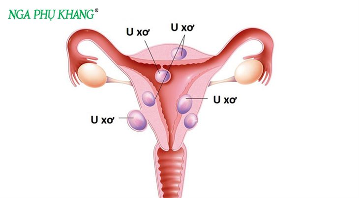 U xơ tử cung thường xuất hiện ở phụ nữ trong độ tuổi sinh sản
