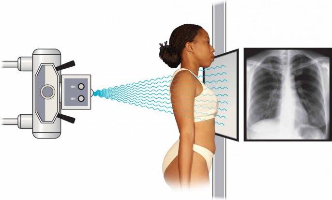 Chụp X-quang giúp hỗ trợ tầm soát ung thư phổi