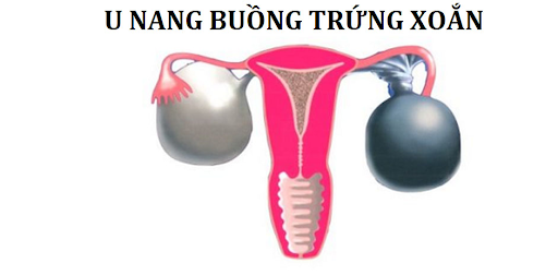 u-nang-buong-trung-khong-duoc-dieu-tri-som-co-the-gay-xoan-u-nang