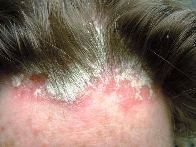 Nhận biết bệnh vẩy nến da đầu như thế nào?
