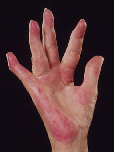Biểu hiện tổn thương da ở bệnh nhân lupus ban đỏ