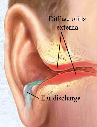 Bạn có biết: Viêm tai ngoài có thể gây tử vong