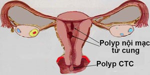 DẤU HIỆU VÀ BIẾN CHỨNG CỦA POLYP NỘI MẠC TỬ CUNG