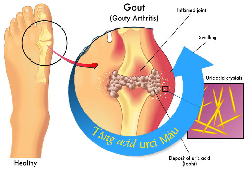 TĂNG AXIT URIC MÁU VÀ MỐI LIÊN HỆ VỚI BỆNH GÚT