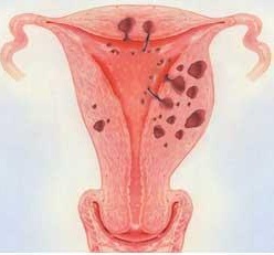 Bệnh lạc nội mạc tử cung là gì?