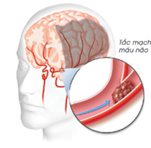 Tai biến mạch máu não và những con số tại Việt Nam