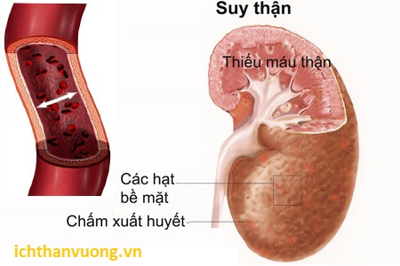 Những nguyên nhân gì dẫn tới suy thận cấp?