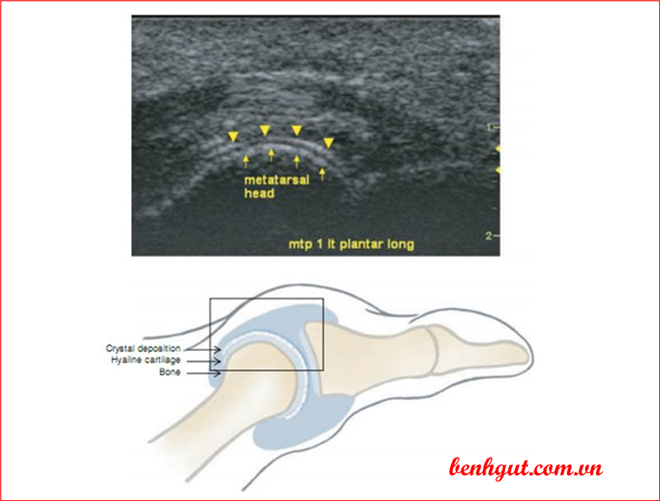 Siêu âm giúp chẩn đoán sớm bệnh gút không triệu chứng