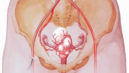 5 yếu tố nguy cơ gây xuất hiện u xơ tử cung