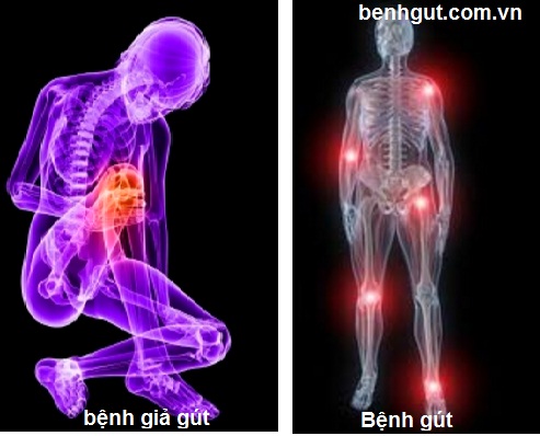 Cách nhận diện đúng bệnh gút và bệnh giả gút