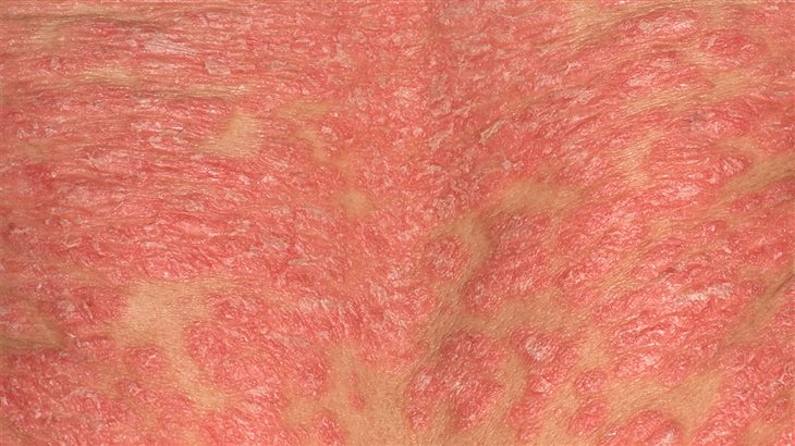 Vẩy nến thể đỏ da toàn thân không chỉ là bệnh ngoài da