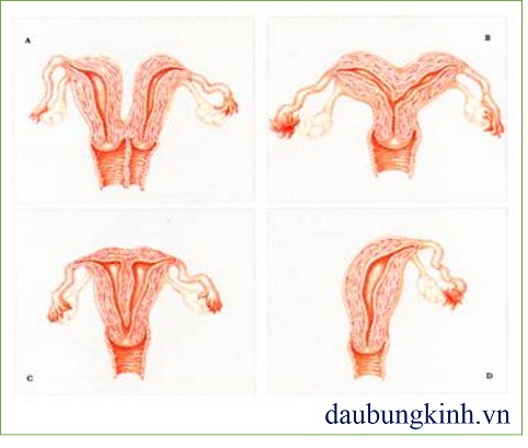 Tìm hiểu về triệu chứng và nguyên nhân gây đau bụng kinh