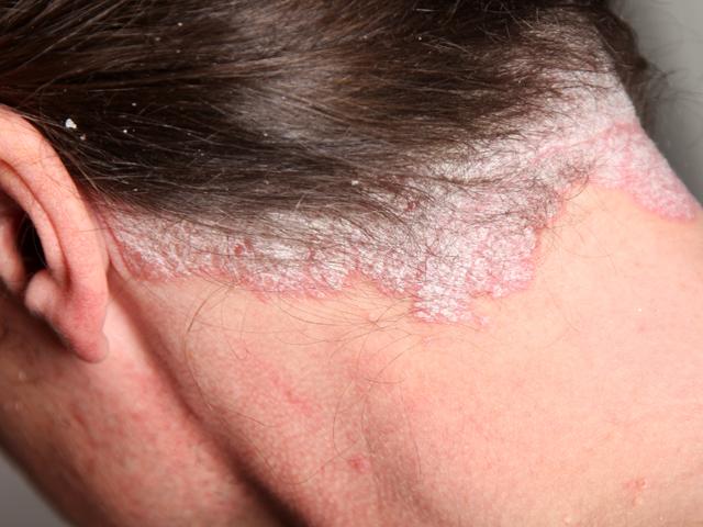 Điều trị bệnh vẩy nến da đầu như thế nào?