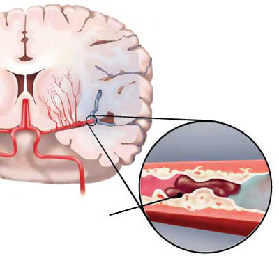 Các bước trong thăm khám chẩn đoán nhồi máu não cấp