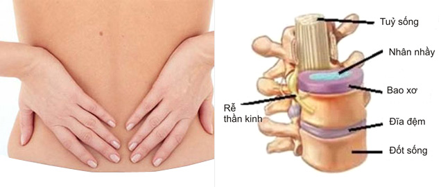 Bất ngờ: Chữa bệnh đau lưng không cần phẫu thuật