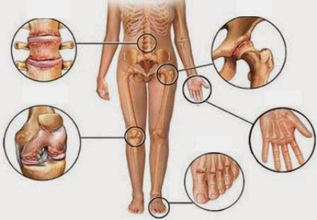 Chữa bệnh viêm đa khớp như thế nào là tốt nhất?