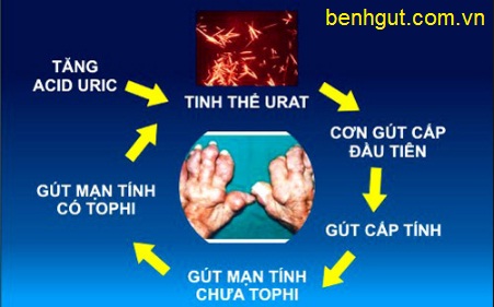 Cảnh báo: Bệnh gút sẽ trở nên nguy hại nếu không điều trị thích hợp