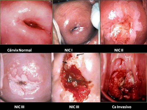 Báo động u xơ tử cung dẫn tới ung thư ác tính