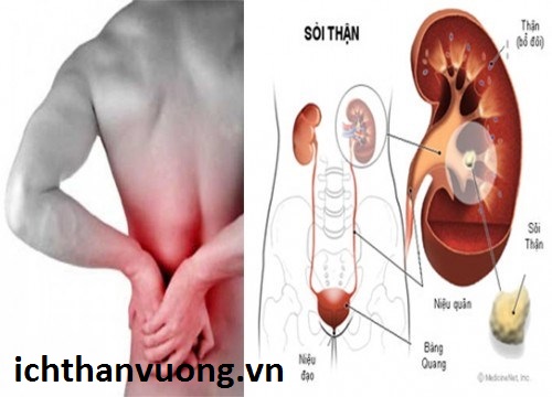 Hết sỏi thận, đau lưng sau 30 năm nhờ phương pháp này