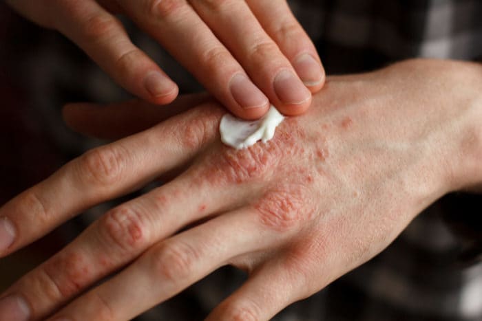 ĐỪNG BAO GIỜ NHẦM LẪN GIỮA VẨY NẾN VÀ ECZEMA?