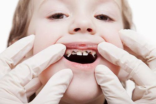 4 thông tin nên biết ngay để phòng ngừa biến chứng sâu răng