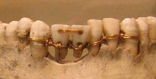 Người cổ đại biết chữa đau răng, sâu răng từ 7.000 năm TCN