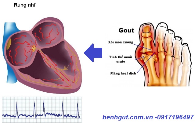 Nghiên cứu mới về mối liên hệ giữa bệnh gút với nguy cơ rung nhĩ