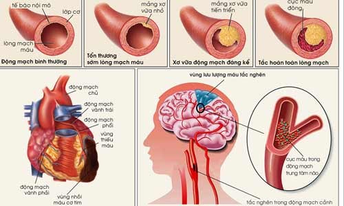 Liệu bạn có nguy cơ cao bị đột quỵ không?