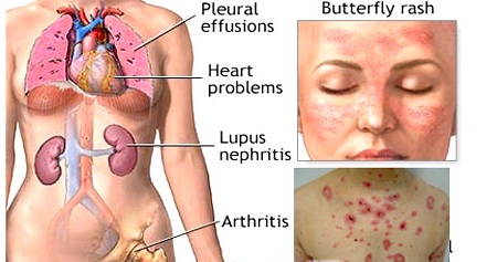 Tại sao suy thận luôn đồng hành với bệnh nhân lupus?