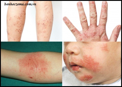10 điều có thể bạn chưa biết về bệnh eczema