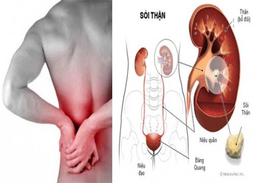 Khổ sở vì sỏi thận tái phát - Đối phó bằng cách nào?