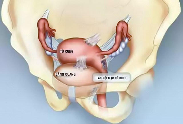 Lạc nội mạc trong cơ tử cung (lạc nội mạc tử cung) là gì?