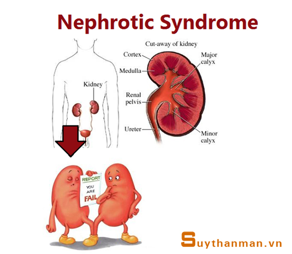 Lơ là hội chứng thận hư: Khi suy thận đừng đổ "tại số"